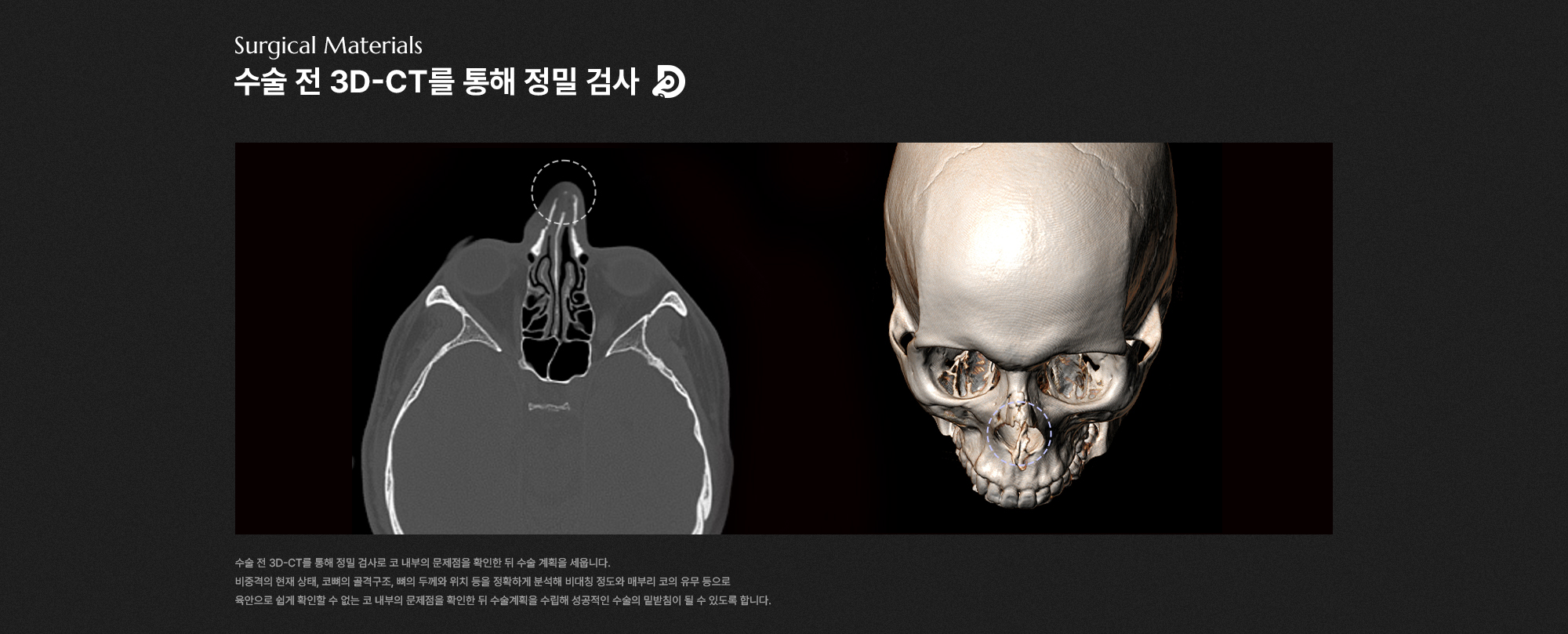 맞춤코수술